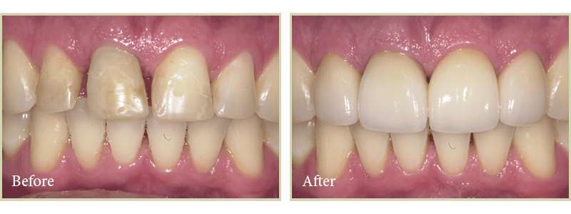 Smile gallery case by Dr. Bruno da Costa, a Beaverton cosmetic dentist. 
