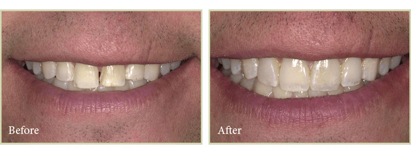 Smile gallery case by Dr. Bruno da Costa, a Beaverton cosmetic dentist. 