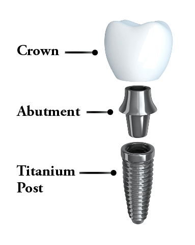 Dental implants infographic