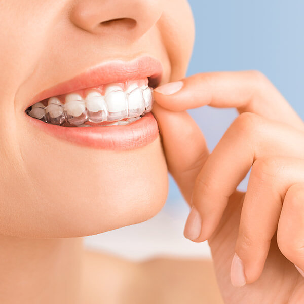 Close up Invisalign® being placed onto teeth